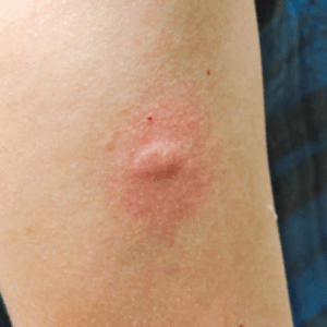 Dermatiti, scottature e punture di insetti