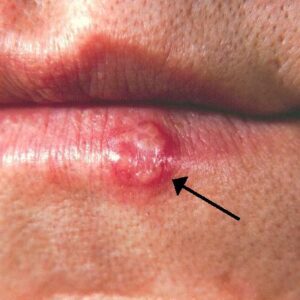 Herpes