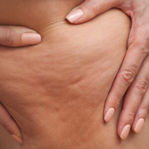 Cellulite e smagliature